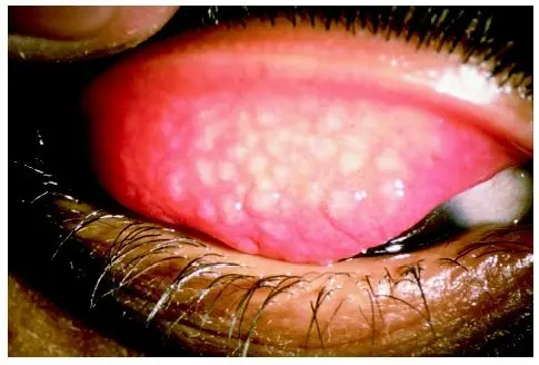 Trachoma: what is this bacterial eye infection?