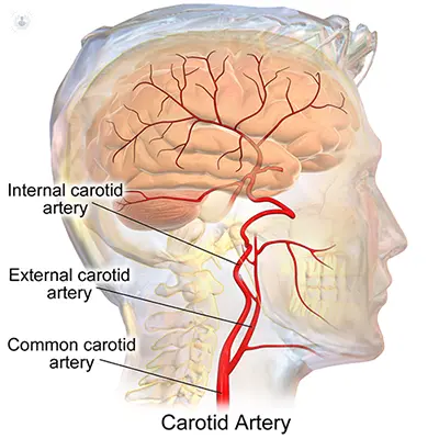 Transient ischemic attack (TIA): symptoms and consequences