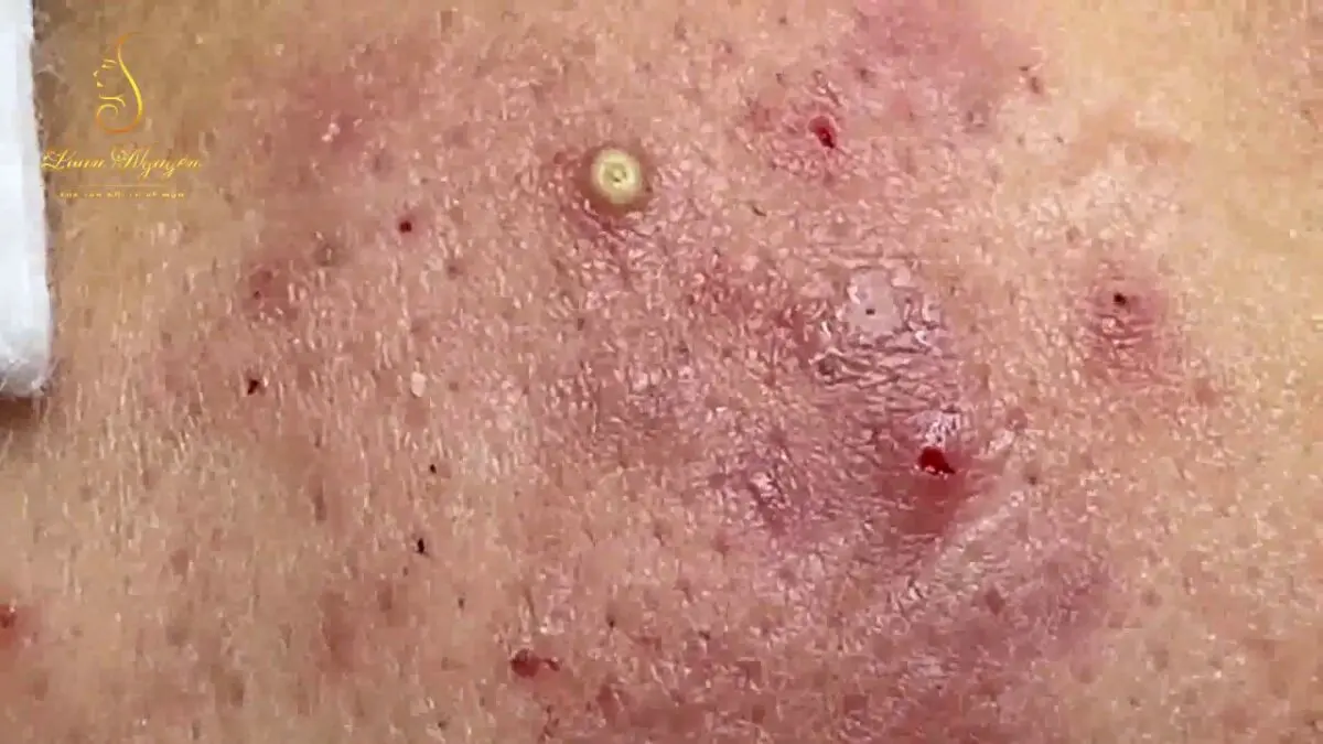 Treating inflamed acne. Video