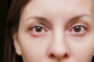 Behandlung von Gerste im Auge. Video