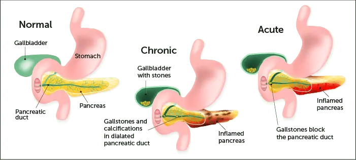 Treatment of chronic and acute pancreatitis. How to treat pancreatitis at home and folk remedies