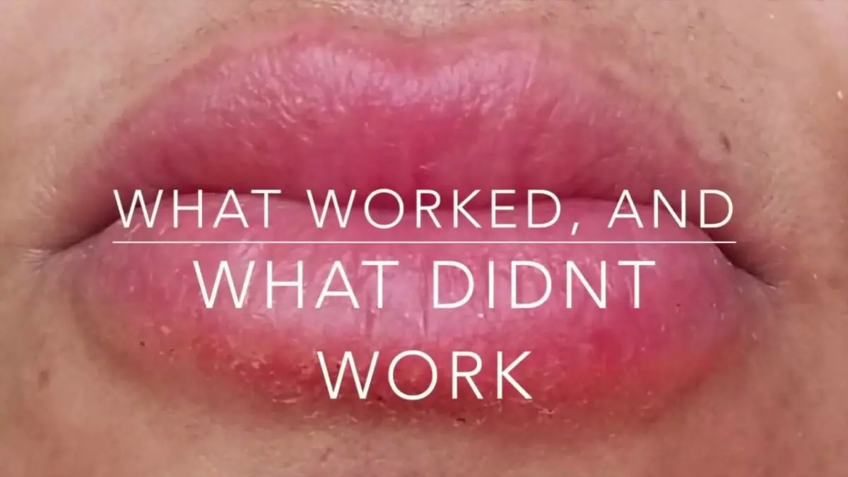 Treatment of swelling on the lips. Video