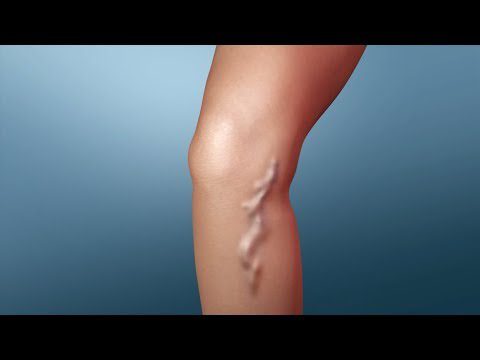 Treatment of varicose veins. Video