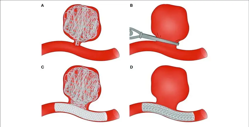 Treatments for ruptured aneurysm