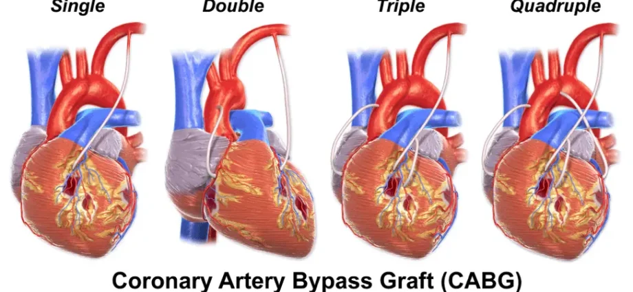 Triple bypass