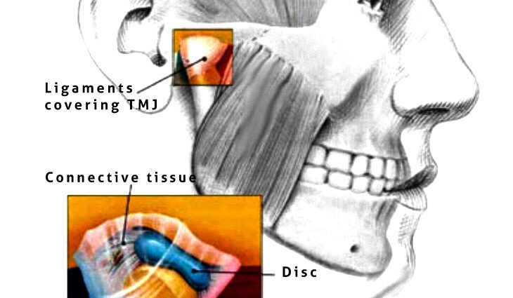 Trismus: အဓိပ္ပါယ်, အကြောင်းရင်းနှင့်ကုသမှု