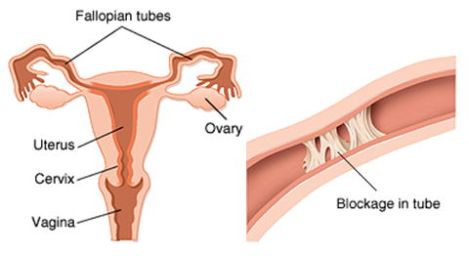 Tubal infertility: what happens if the fallopian tubes are blocked?