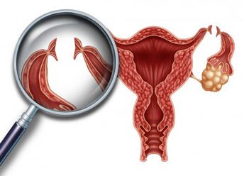 Ligature Tubali: operazione, età, effettu nantu à a menstruazione