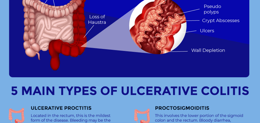 دلچسپي ۽ سپورٽ گروپن جي Ulcerative colitis سائيٽون