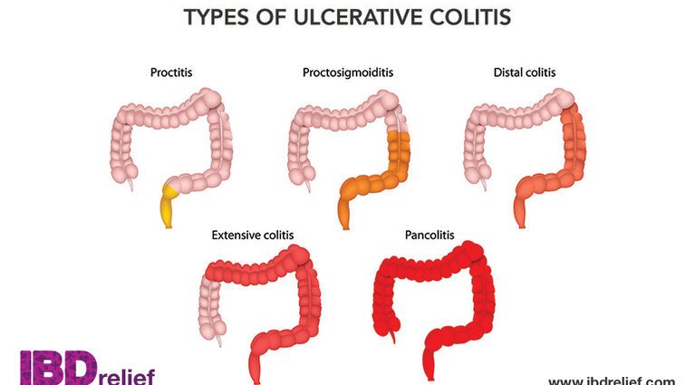 Ulcerozni kolitis (UC ili ulcerozni kolitis)