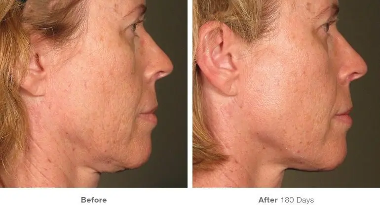 Ulthera System: the perfect face without pain and surgery