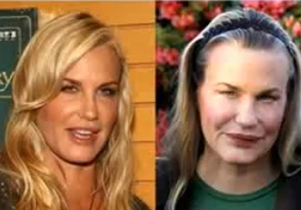 Unsuccessful plastic surgery of stars before and after photos