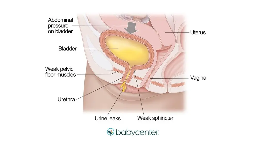 Urinary incontinence during pregnancy: preventing urine leakage