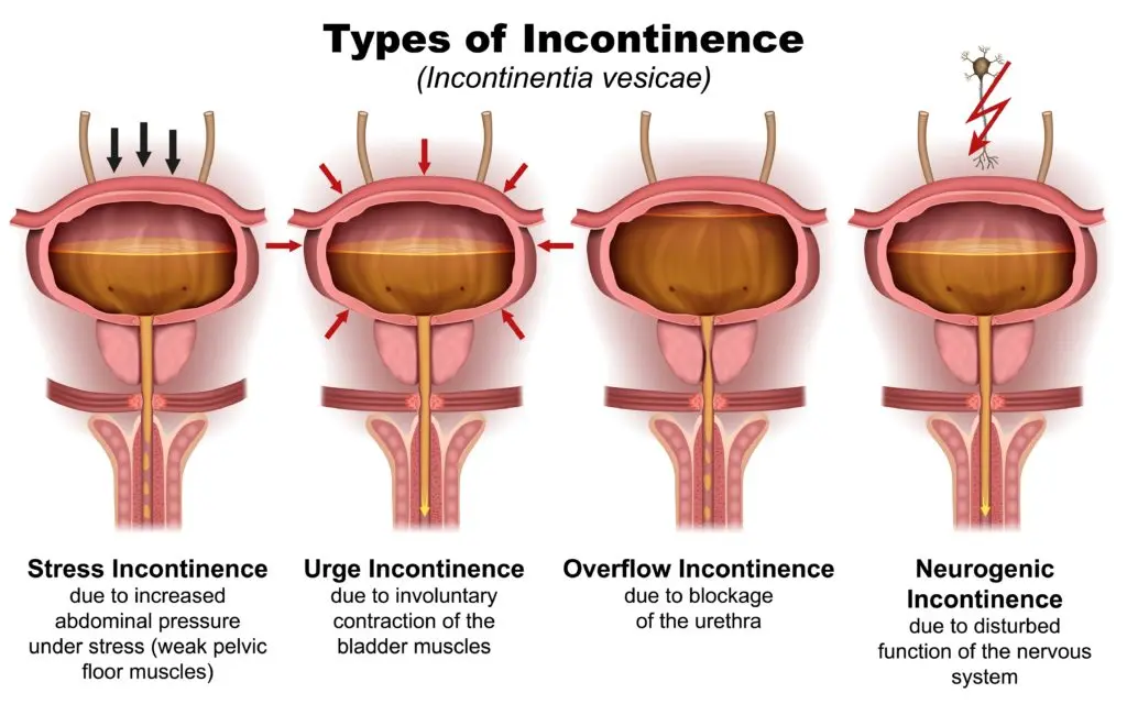 Urinary incontinence