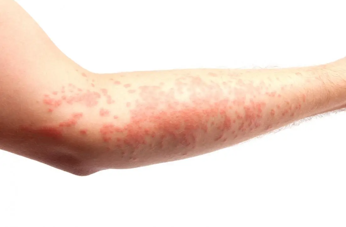 Urticaria: recognizing a hives attack