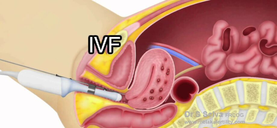 Uterine adenomyosis: diagnosis and treatment. Video