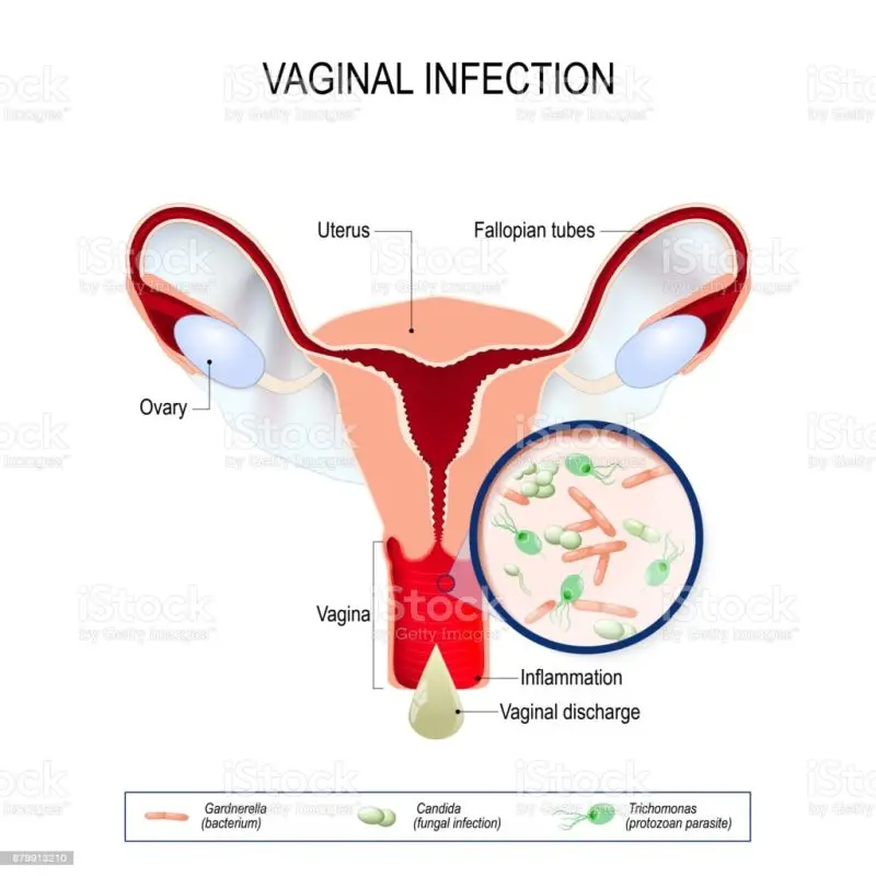 Vaginitis &#8211; Sites of interest