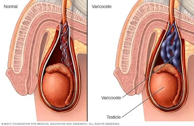 Varicocele: definition, causes, treatments