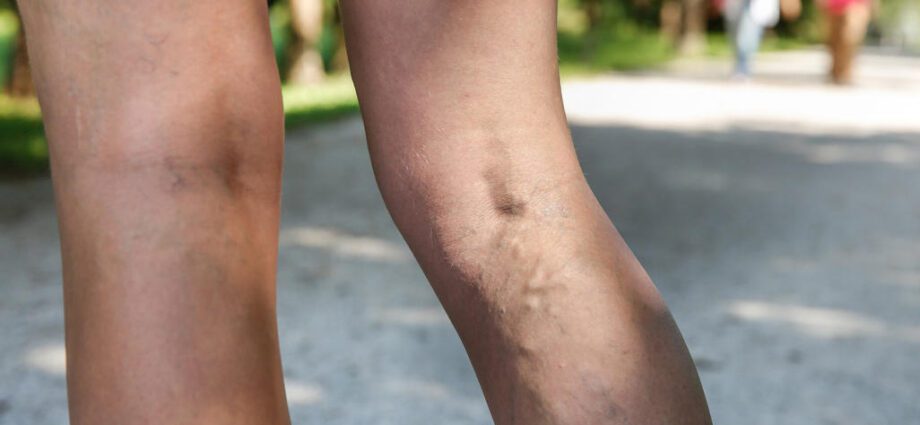 Varicose veins and pregnancy