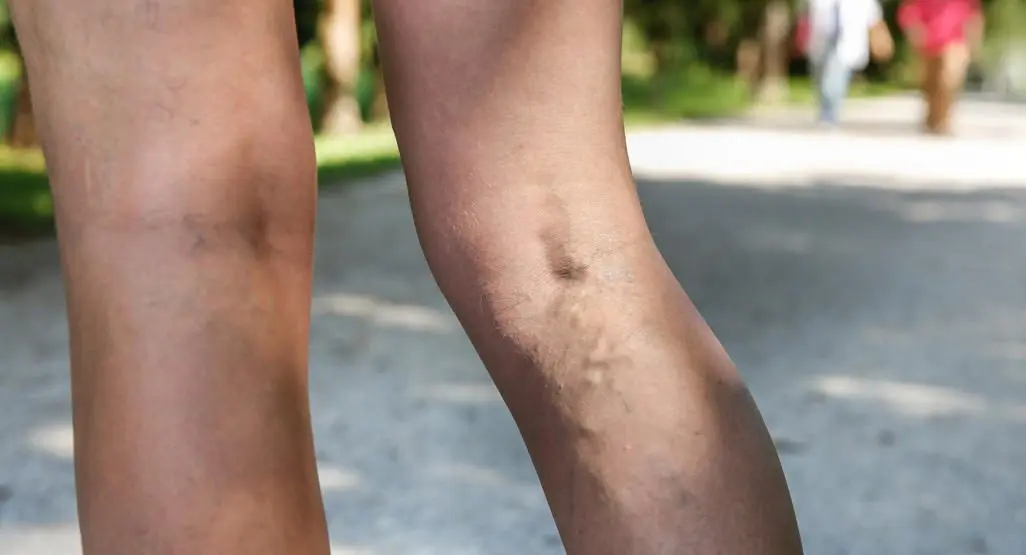 Varicose veins and pregnancy