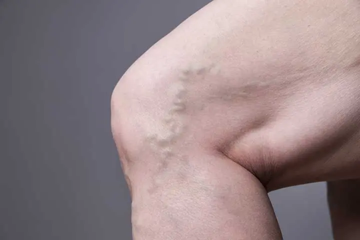 Varicose veins: complementary approaches