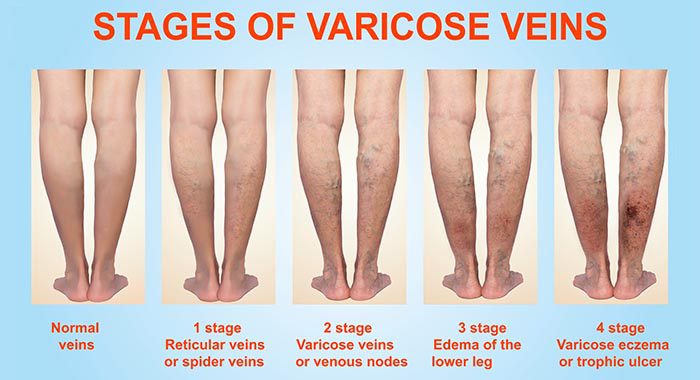 Varicose veins on the legs: why does it appear and whether it is necessary to wear compression underwear