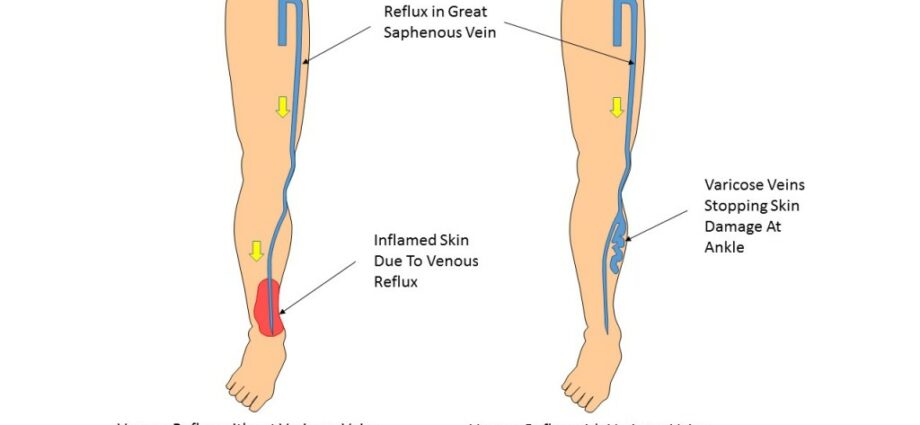 Varicose veins - ကျွန်ုပ်တို့၏ဆရာဝန်၏အမြင်
