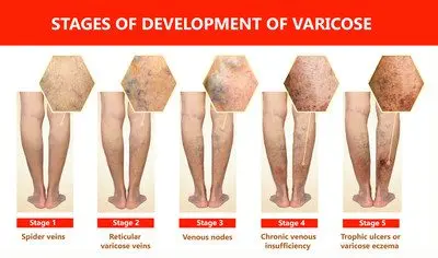 Varicose veins &#8211; Sites of interest