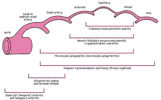 Vasculitis of small capillaries