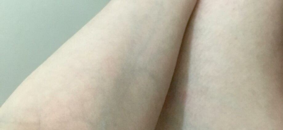 Veins on the legs, arms, chest are visible: what to do