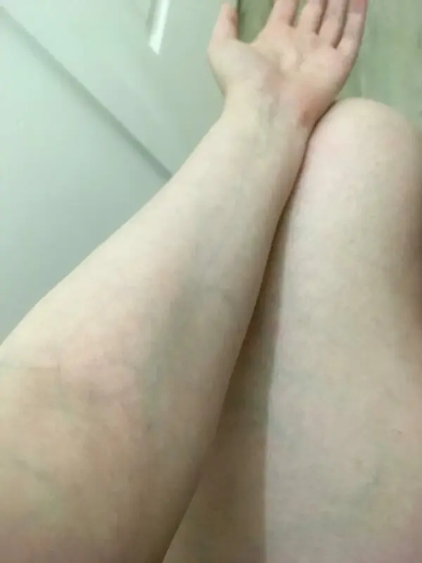 Veins on the legs, arms, chest are visible: what to do