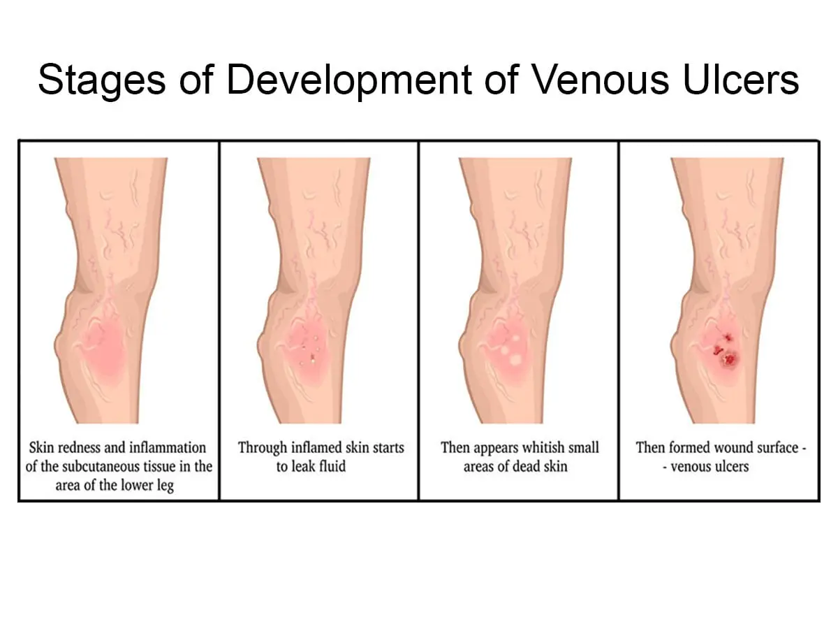 Venous ulcer