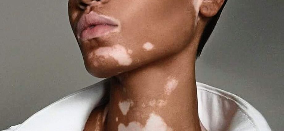 I-vitiligo