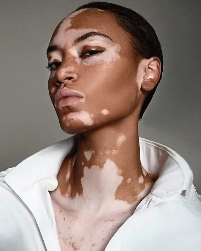 Vitiligo