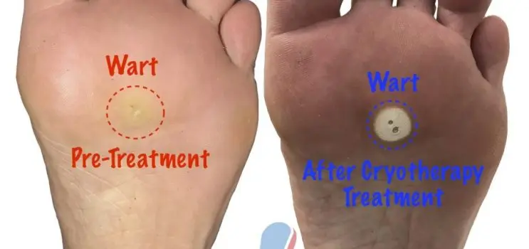 Wart on the foot: how to treat bruises? Video