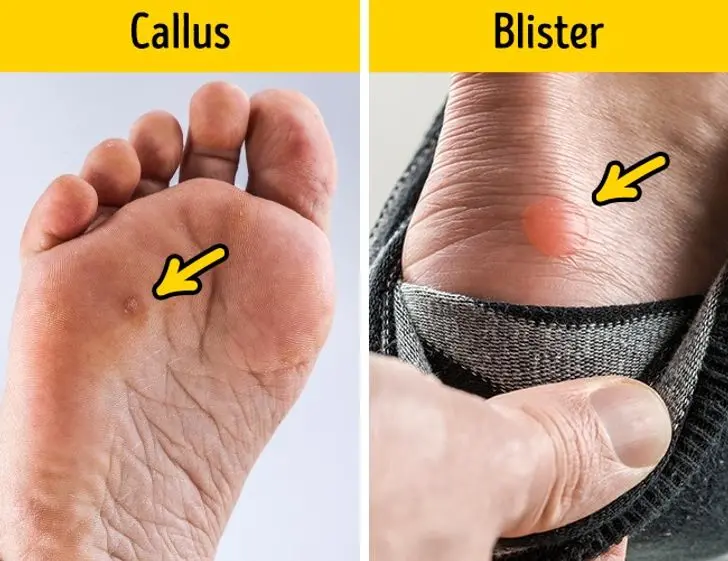 Water callus: what to do with it and how to quickly heal