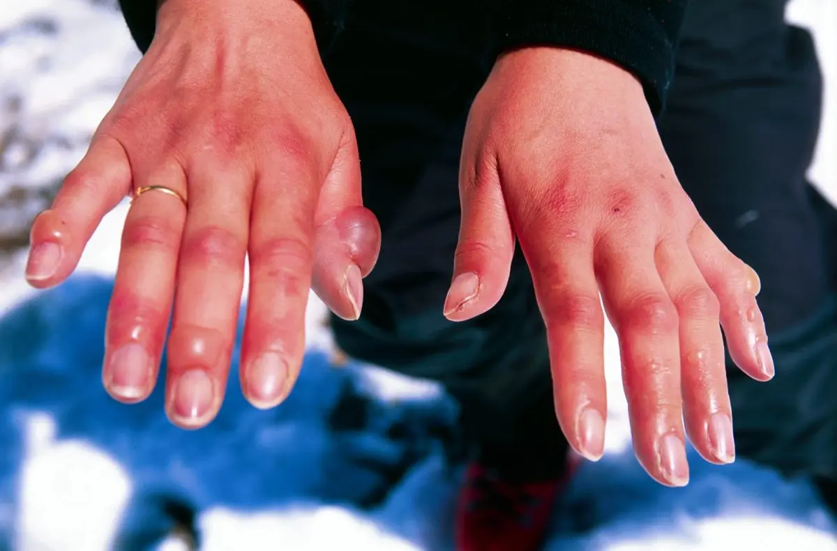 What are frostbite?