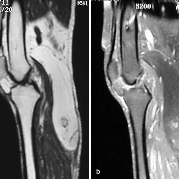 What are the complementary approaches to lipoma?