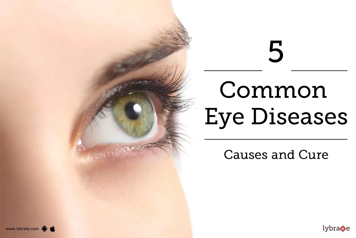 What are the main eye diseases?