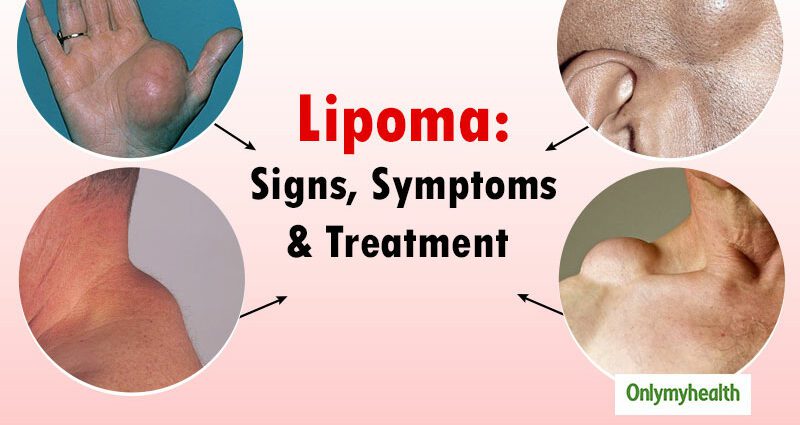Millised on lipoomi sümptomid?