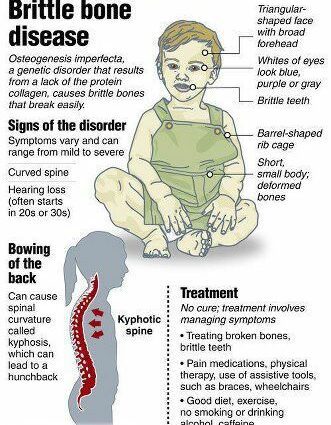 What are the symptoms of Osteogenesis Imperfecta?