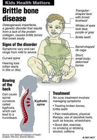 What are the symptoms of Osteogenesis Imperfecta?