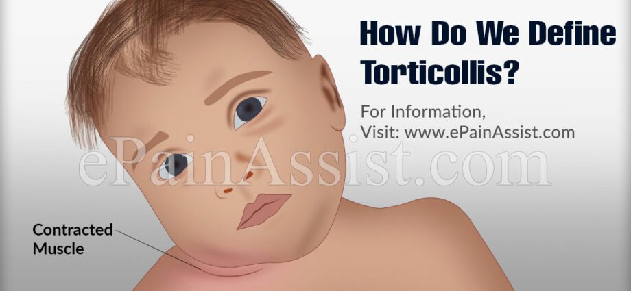 Cilat janë simptomat e tortikollit?