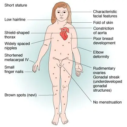 What are the symptoms of Turner syndrome?