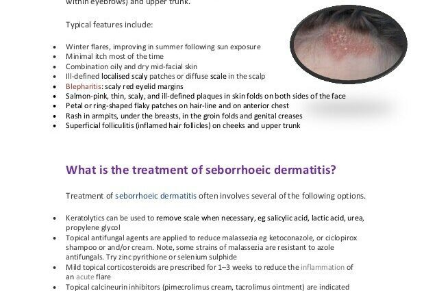 What Are The Treatments For Seborrheic Dermatitis Healthy Food Near Me