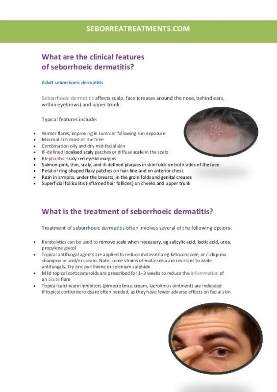 What are the treatments for seborrheic dermatitis?