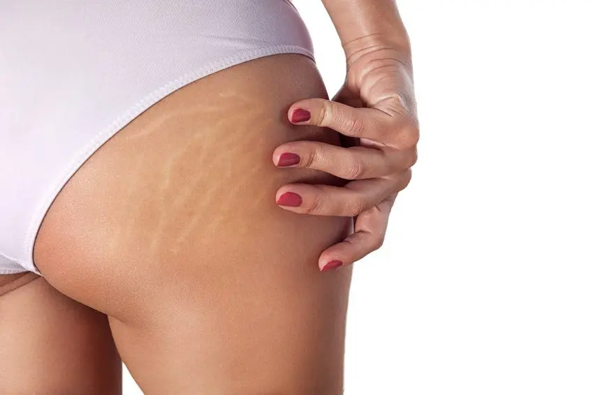 What causes stretch marks on the hips: reasons