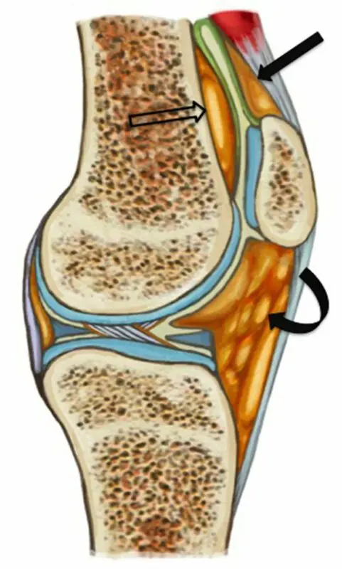 What is a fat pad and how to deal with it