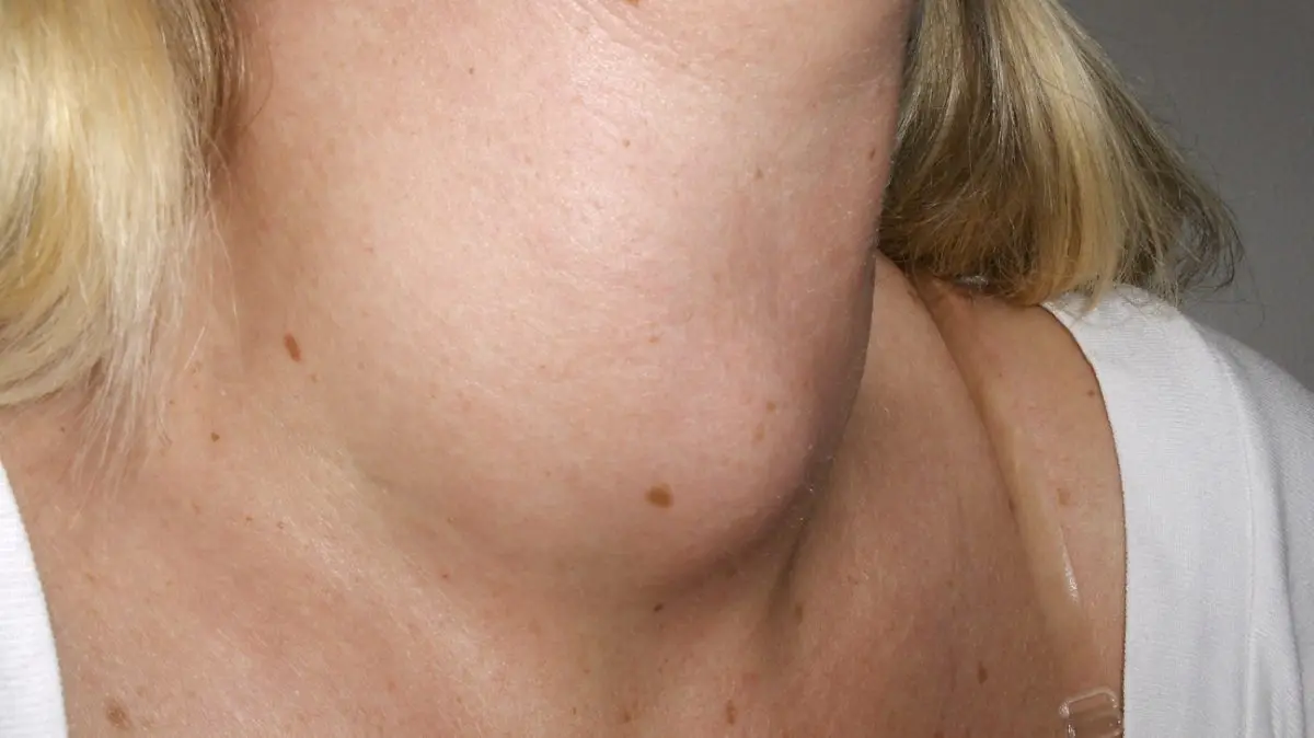 What is a goiter?