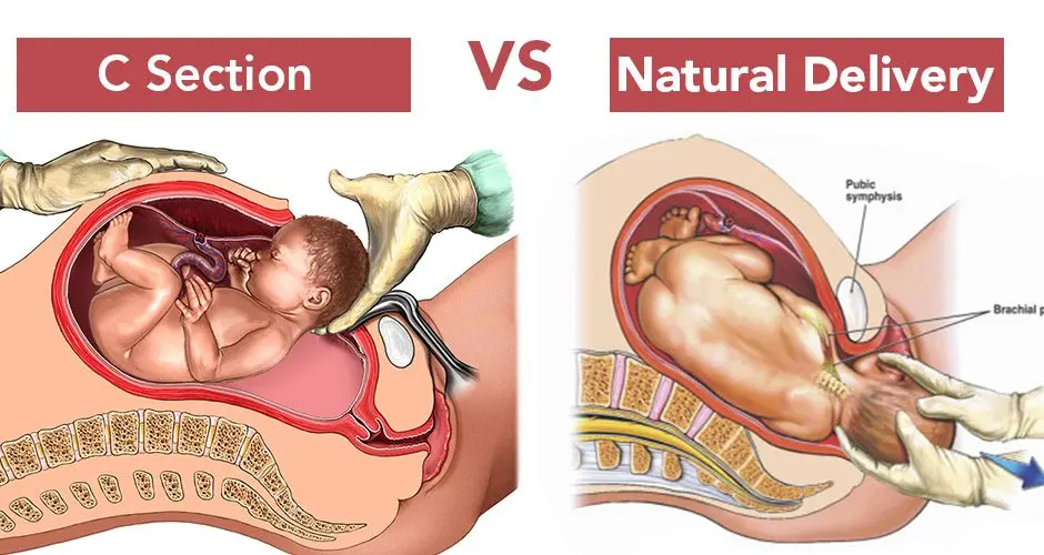 What is a natural cesarean section and how is it different from a regular one